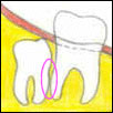 Vertical Bone Impaction